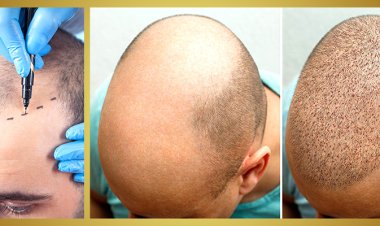Exploring Apollo Cosmetic Clinics for Hair Transplant in Chennai