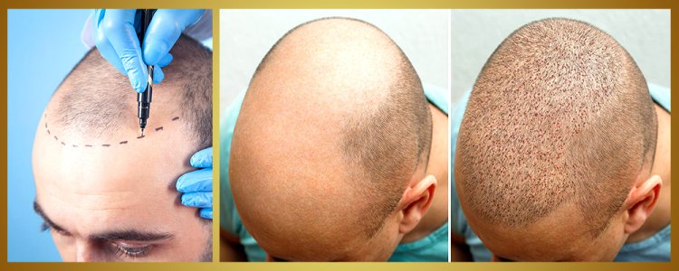 Exploring Apollo Cosmetic Clinics for Hair Transplant in Chennai
