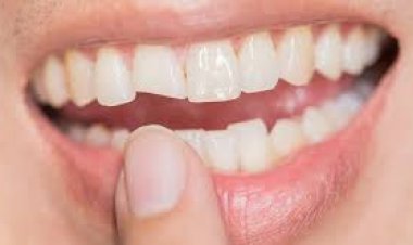 Chipped Crown Tooth Solutions You Can Trust