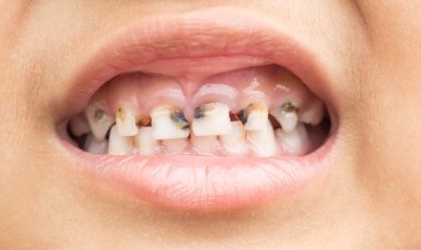 Tooth Decay in Preschoolers: Causes, Prevention & Tips