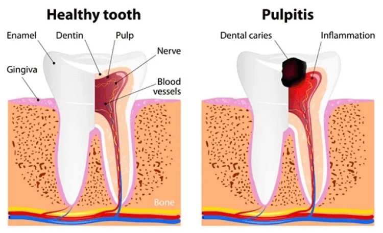 Understanding Irreversible Pulpitis: Causes and Symptoms