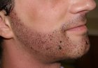 Choosing the Best Clinic for Beard Hair Transplant in Islamabad