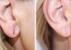 Earlobe Correction in Islamabad for Re-Piercing Preparation