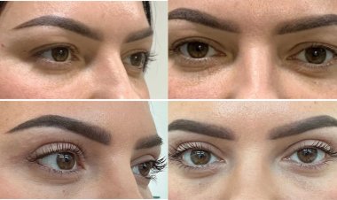 Does Upper Blepharoplasty Actually Fix Drooping Eyelids and Hooded Eyes? Here Is the Real Answer