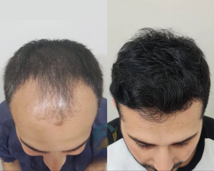 Natural Hair Restoration with Hair Transplant in Islamabad