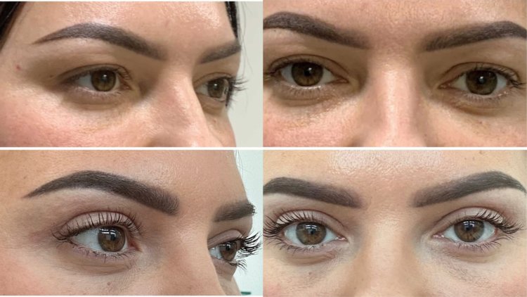 Does Upper Blepharoplasty Actually Fix Drooping Eyelids and Hooded Eyes? Here Is the Real Answer