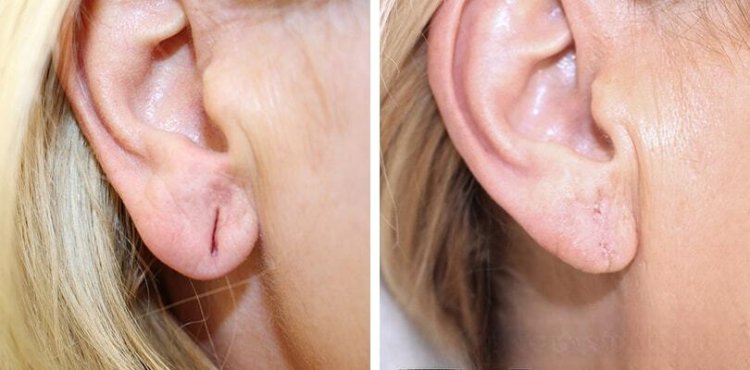 Earlobe Correction in Islamabad for Re-Piercing Preparation