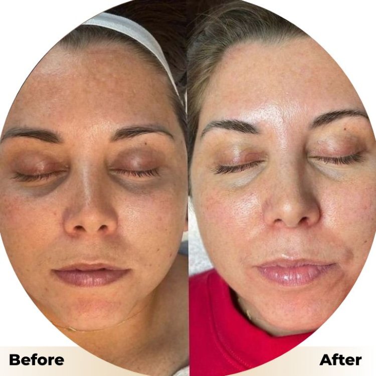 Hydrafacial in Islamabad: Achieve Clear and Glowing SkinThe Rise of Modern Facial Treatments