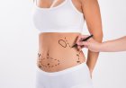 Liposuction in Dubai: The Secret to a Sculpted Physique