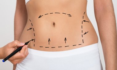 Affordable Options for Bariatric Surgery in Islamabad