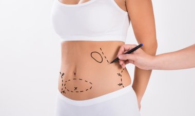 Liposuction in Dubai: The Secret to a Sculpted Physique