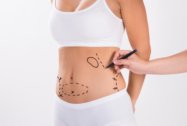 Liposuction in Dubai: The Secret to a Sculpted Physique