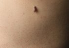 Home Remedies vs. Clinical Treatments for Filiform Warts