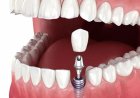 Long-Term Smile Stability Through Advanced Dental Implant Care in Islamabad