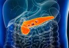 Why Is Pancreatic Cancer So Hard to Detect Early?