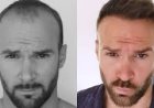 Best Hair Transplant Turkey: Results Timeline What to Expect Month by Month