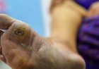 How Dangerous Is a Foot Ulcer If You Don't Have Diabetes?