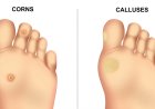 Corn, Callus, or Something Else? How to Identify Foot Conditions