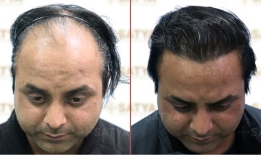 Best Hair Transplant Clinic in India: Your Guide to Natural Hair Restoration at Satya