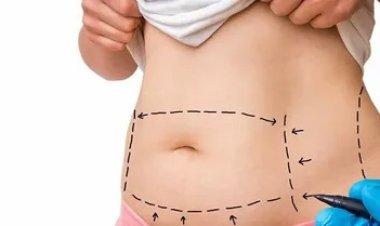 How Long Do Liposuction Results Last? Islamabad Experts Explain
