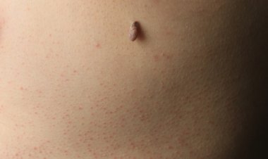 Home Remedies vs. Clinical Treatments for Filiform Warts