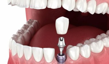 Long-Term Smile Stability Through Advanced Dental Implant Care in Islamabad