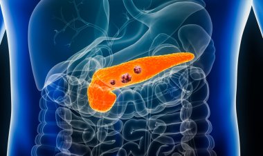 Why Is Pancreatic Cancer So Hard to Detect Early?