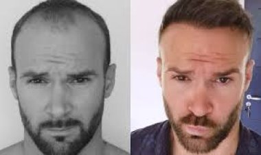 Best Hair Transplant Turkey: Results Timeline What to Expect Month by Month