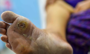 How Dangerous Is a Foot Ulcer If You Don't Have Diabetes?