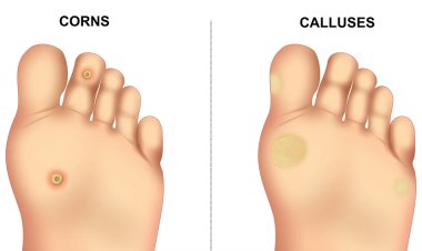 Corn, Callus, or Something Else? How to Identify Foot Conditions