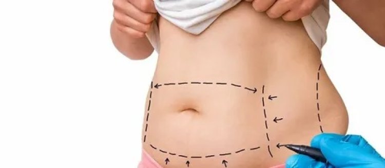 How Long Do Liposuction Results Last? Islamabad Experts Explain