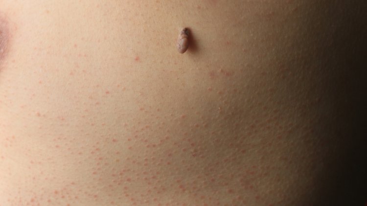Home Remedies vs. Clinical Treatments for Filiform Warts