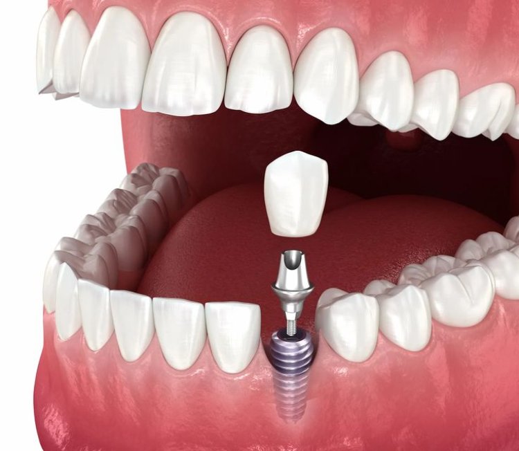 Long-Term Smile Stability Through Advanced Dental Implant Care in Islamabad