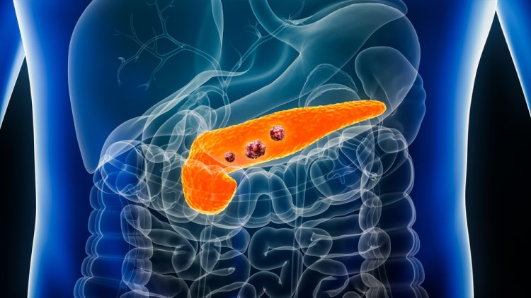 Why Is Pancreatic Cancer So Hard to Detect Early?