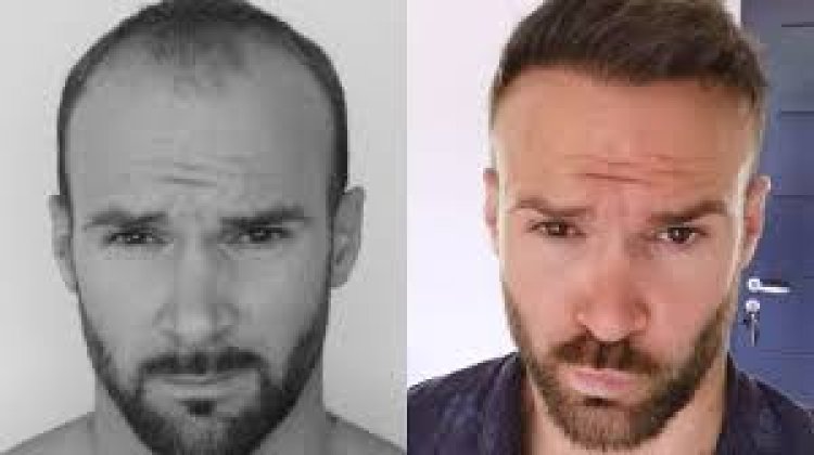 Best Hair Transplant Turkey: Results Timeline What to Expect Month by Month