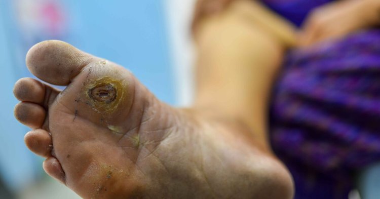How Dangerous Is a Foot Ulcer If You Don't Have Diabetes?