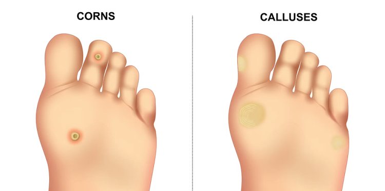 Corn, Callus, or Something Else? How to Identify Foot Conditions