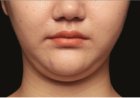Say Goodbye to Neck Fat with Double Chin Liposuction