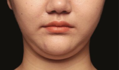 Say Goodbye to Neck Fat with Double Chin Liposuction