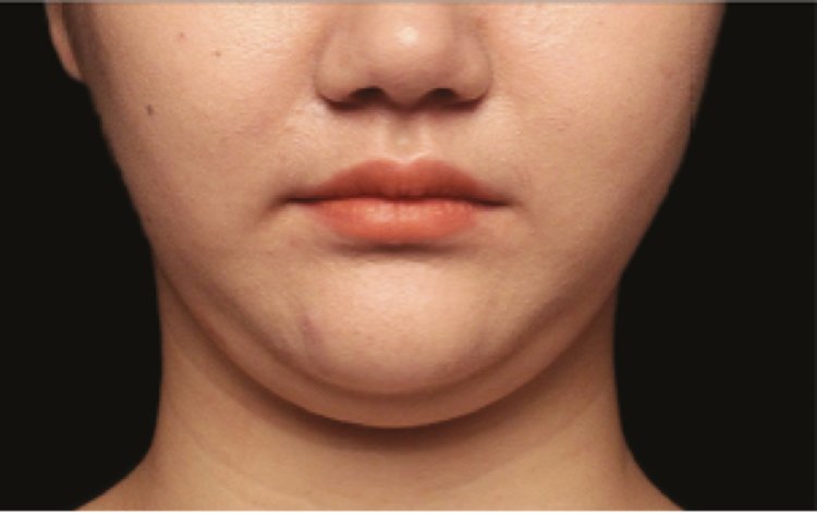 Say Goodbye to Neck Fat with Double Chin Liposuction